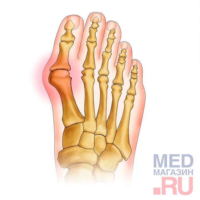 Бандаж при вальгусной деформации HV-33I Orliman