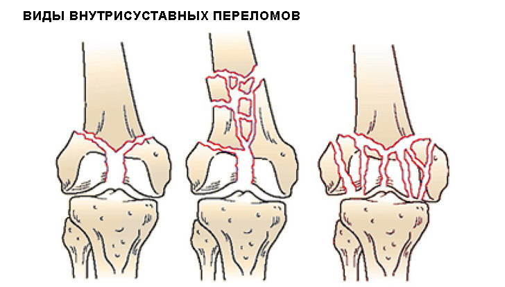 Название всех переломов thumbnail