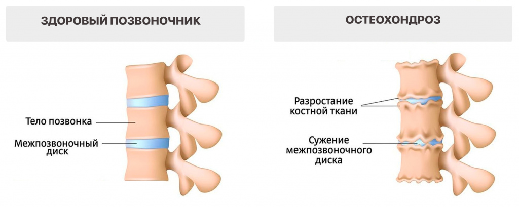 Симптомы остеохондроза